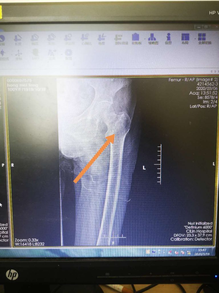 【重圆“行走梦”】慈林医院骨科中心成功为百岁老人实施人工股骨头置换术！