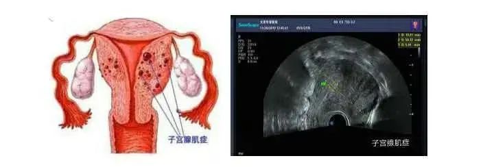 【特别推荐】慈林医院无创技术——高强度超声聚焦刀治疗子宫腺肌症