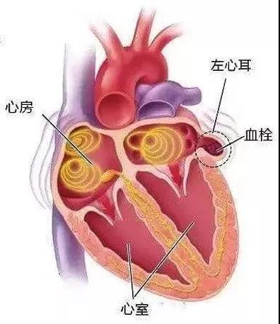 慢性房颤新曙光，慈林医院成功完成首例左心耳夹闭手术